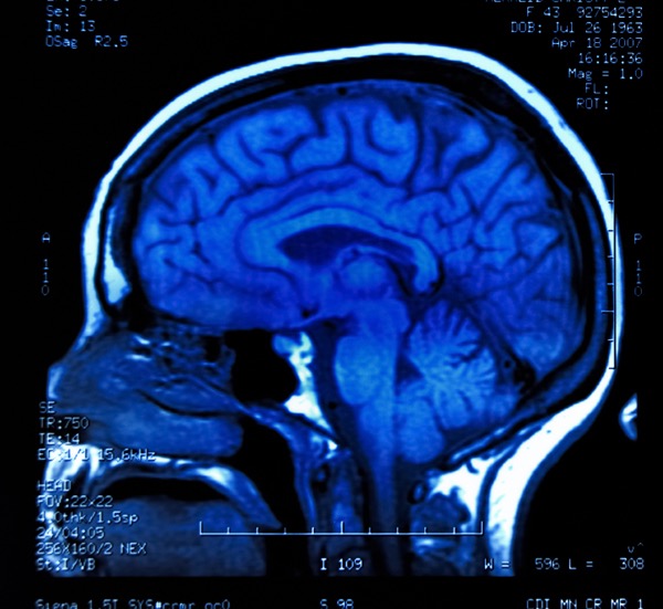 MRI of brain